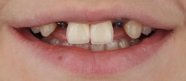 Имплантация зубов верхней челюсти